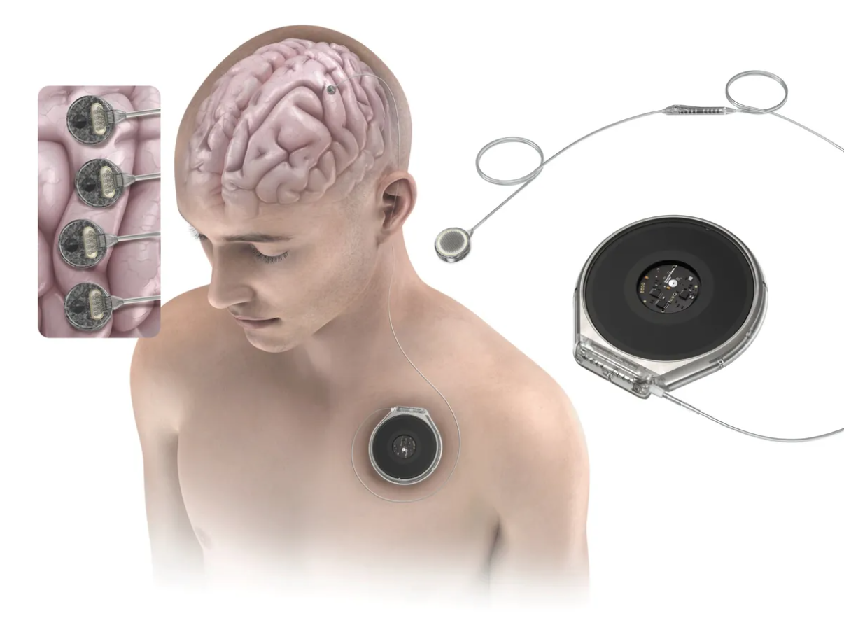 cấy chip - Ảnh 1.