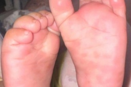 Hiếm gặp: Bé 4 tháng tuổi mắc giang mai