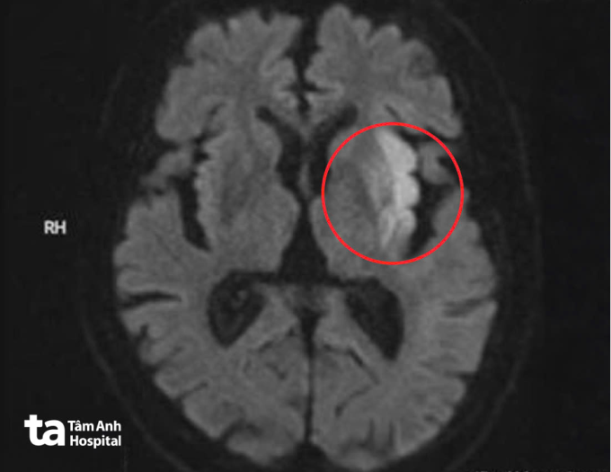 Ảnh MRI cho thấy vùng nhồi máu cấp diện rộng ở bán cầu não trái, ảnh hưởng vùng vận động và ngôn ngữ của ông Trung. Ảnh: Bệnh viện Đa khoa Tâm Anh