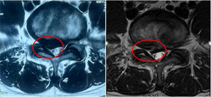 Kết quả chụp cho thấy phần thoát vị co lại sau đốt sóng cao tần. Ảnh: Bệnh viện Đa khoa Tâm Anh