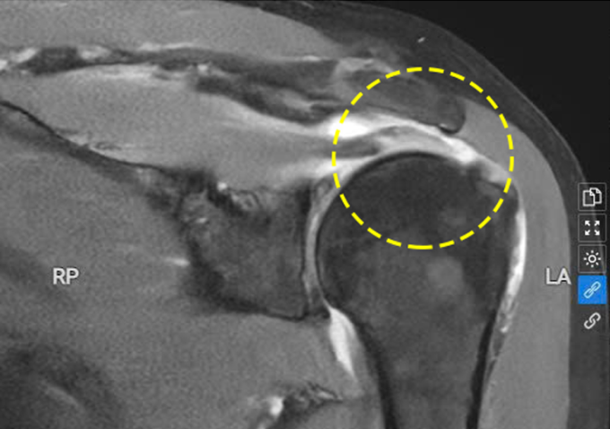 Phim chụp MRI cho thấy gân trên gai của bà Liên bị đứt. Ảnh: Bệnh viện Đa khoa Tâm Anh