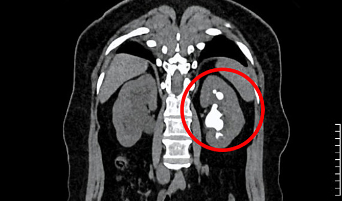 Sỏi san hô cứng, kích thước lớn (màu trắng trong hình tròn đỏ) ở thận trái gây đau đớn cho người bệnh. Ảnh: Bệnh viện Đa khoa Tâm Anh