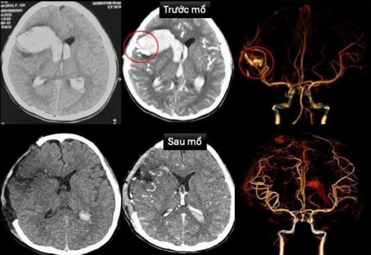 Hy hữu bé gái 13 tuổi bị đột quỵ 1 Vùng xuất huyết do vỡ dị dạng mạch máu não ở bệnh nhi trước và sau phẫu thuật