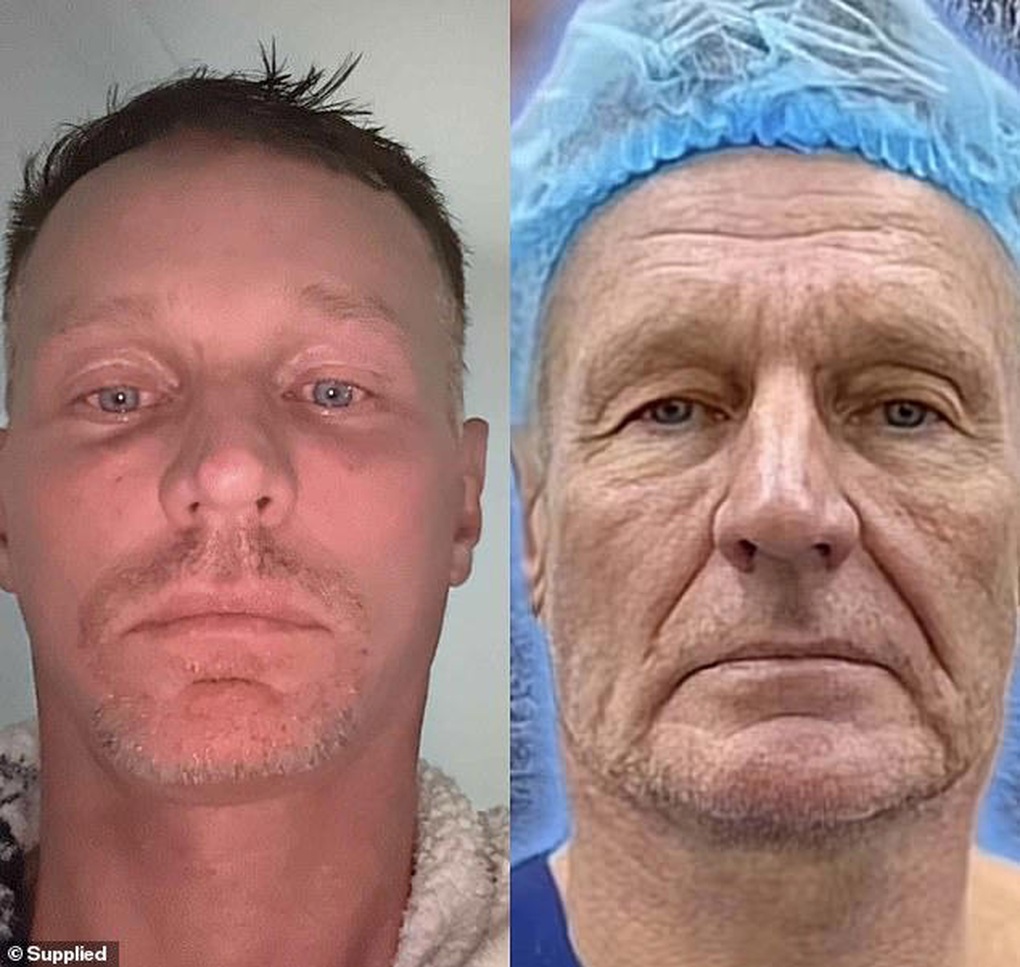 Khách Tây đổi đời sau khi tới Việt Nam phẫu thuật thẩm mỹ - 2