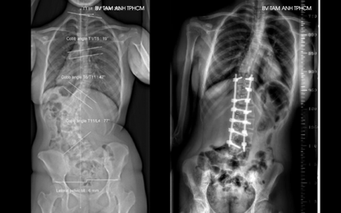 Phim X-quang một người thiếu niên bị cong vẹo cột sống trước (trái) và sau phẫu thuật. Ảnh: Bệnh viện Đa khoa Tâm Anh