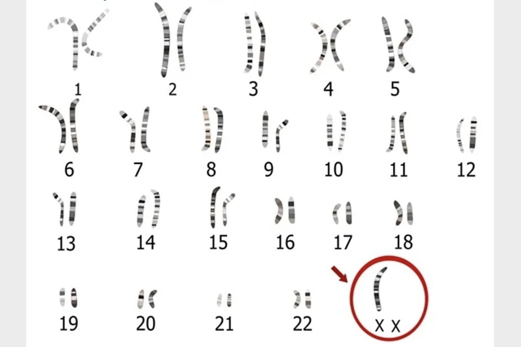 Kỳ lạ, cô gái 24 tuổi vẫn chưa dậy thì vì lỗi ngẫu nhiên của cơ thể - 1