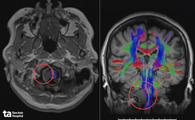 Ảnh MRI 3 Tesla cho thấy khối u nằm sâu vùng góc hành não của bà Hạnh. Ảnh: Bệnh viện Đa khoa Tâm Anh