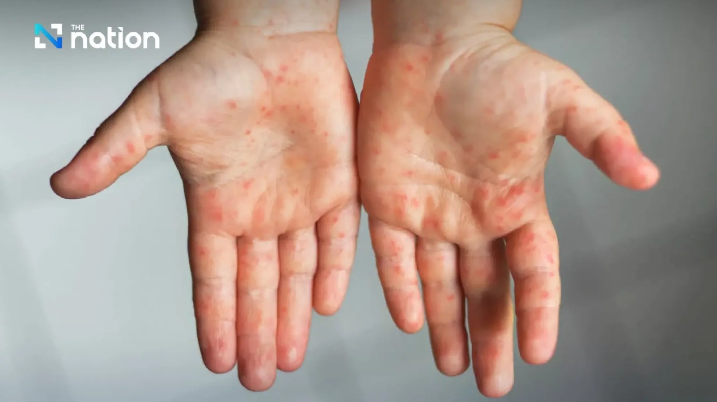 Loại virus đang bùng phát 