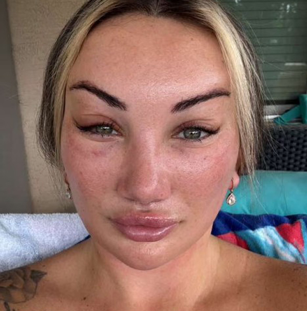 Trào lưu căng da mặt ở tuổi 20-30/Sự thật đằng sau trào lưu U30 phẫu thuật căng da mặt