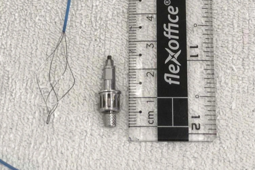 Mất dụng cụ khi làm răng, 2 tuần sau mới phát hiện trong phế quản bệnh nhân - 1