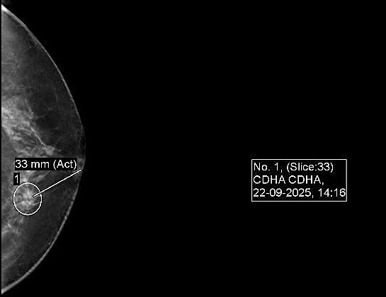 Ảnh tổn thương nghi ngờ ác tính mức độ trung bình. Ảnh: Bệnh viện Đa khoa Tâm Anh