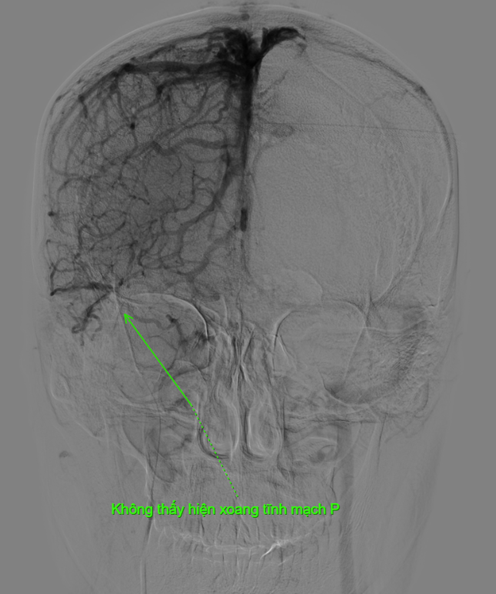 Nam sinh 19 tuổi đau đầu dữ dội 1 tuần, phát hiện huyết khối hiếm gặp - 1