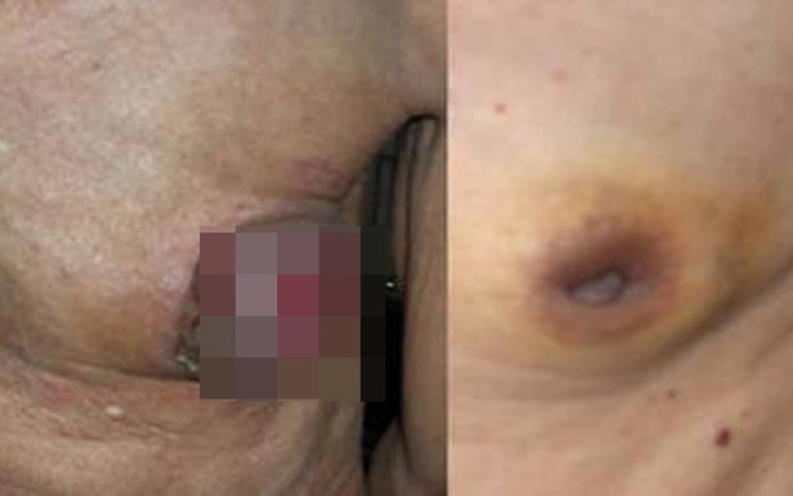 Người đàn ông 61 tuổi phát hiện ung thư vú sau 1 năm sờ thấy khối u ở ngực - Ảnh 2.