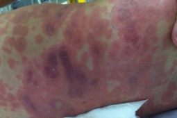 Từ vụ 2 bà cháu tử vong do viêm màng não mô cầu: Bệnh có triệu chứng như thế nào?