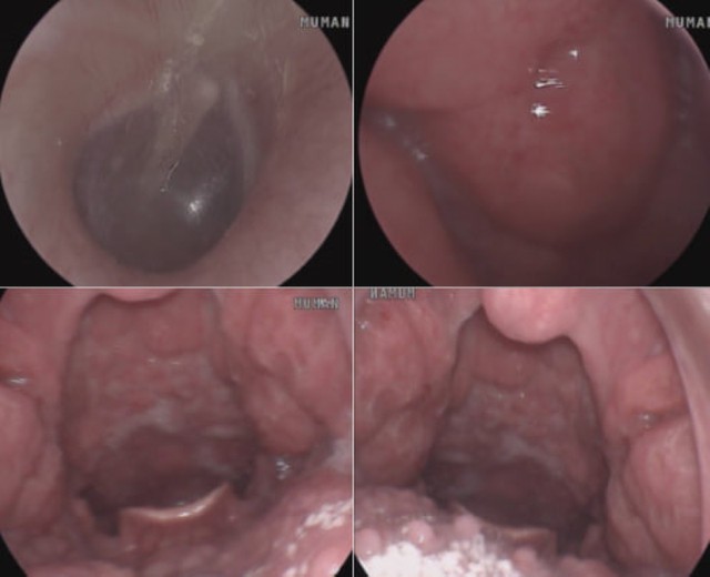 Thanh niên 22 tuổi ở Hà Nội đau họng kéo dài, đi khám mới thừa nhận một sai lầm trong chuyện thầm kín 1 Kết quả nội soi tai mũi họng cho thấy hình ảnh viêm họng xung huyết. Ảnh: BVCC