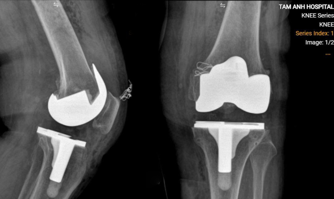 Khớp gối nhân tạo của bà Tịch. Ảnh: Bệnh viện Đa khoa Tâm Anh