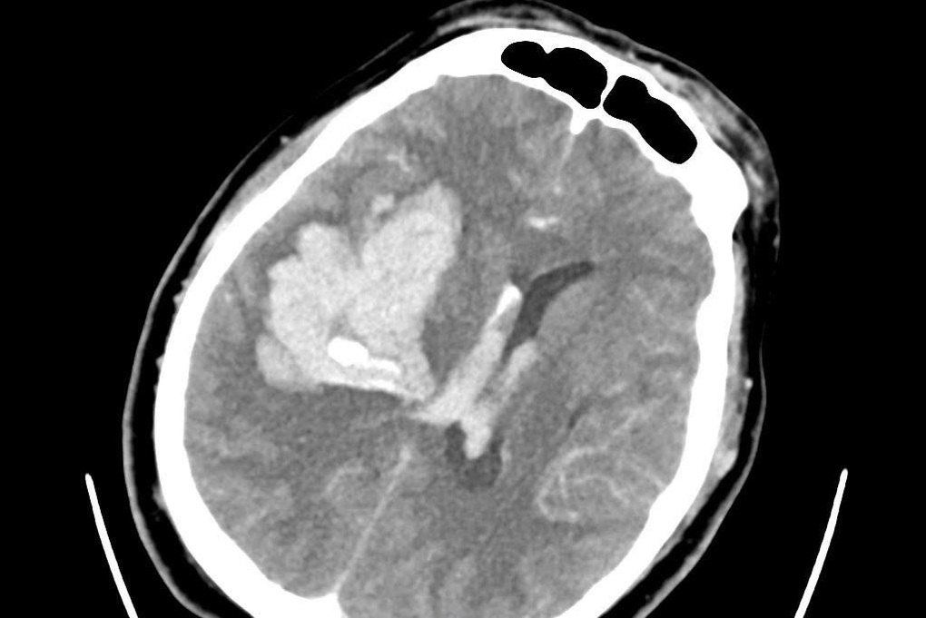 Thêm bệnh nhân hôn mê nặng, vợ vắt chanh vào miệng cầu may nhưng không tỉnh - 1