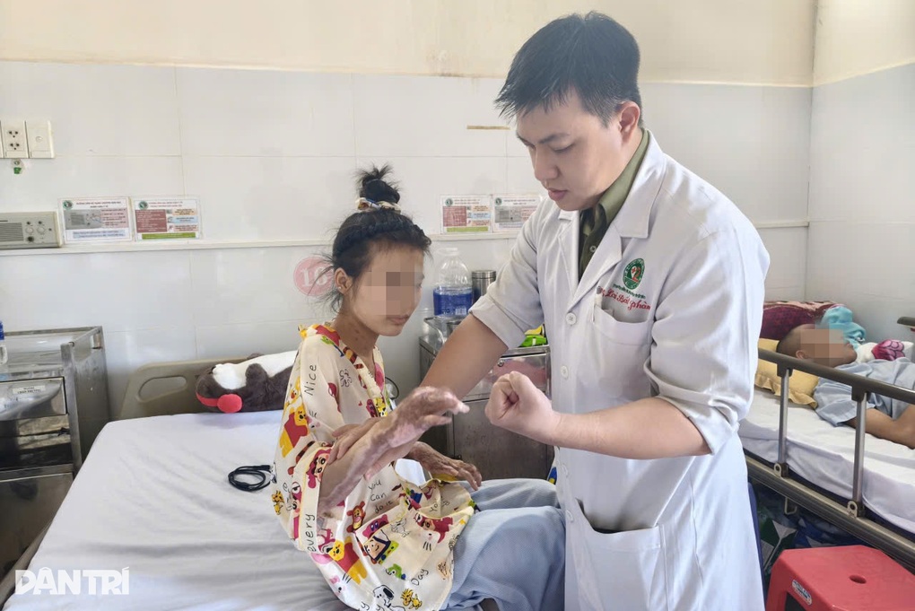 Thiếu nữ 17 tuổi bị bạn đốt keo nến làm cháy khắp người, phải mổ 15 lần - 1