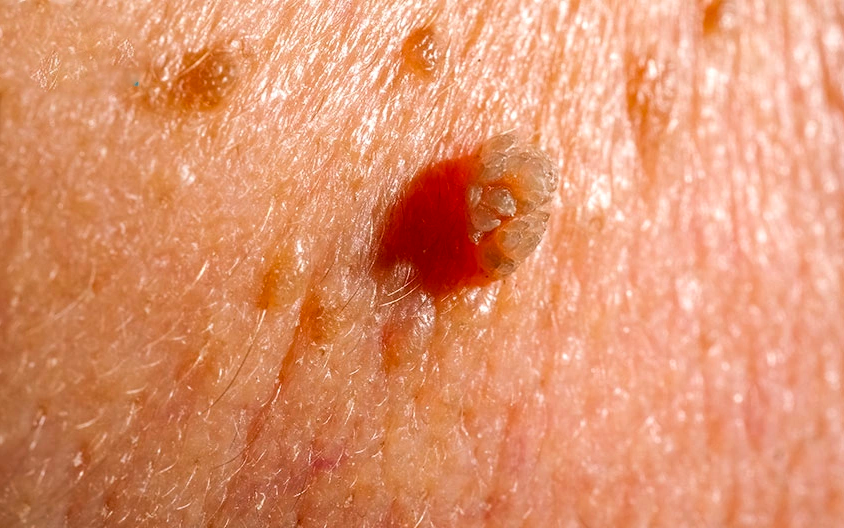 Thieu nu 28 tuoi bi sui mao ga sau quan