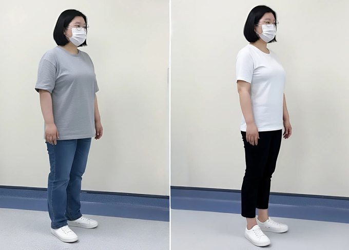 Lê giảm 25 kg sau hơn 4 tháng điều trị giảm cân. Ảnh: Bệnh viện Đa khoa Tâm Anh