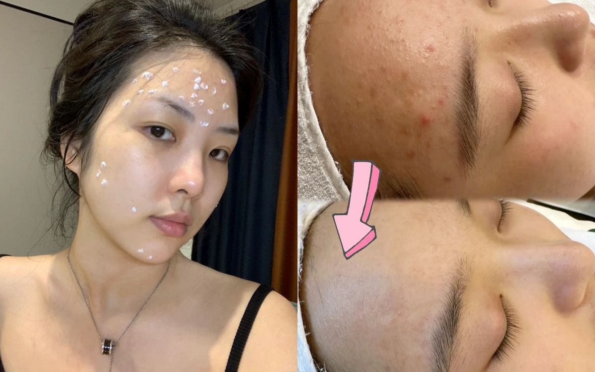 Tôi đã thắng cuộc chiến mụn nhờ 4 sản phẩm bình dân nhưng hiệu quả bất ngờ - Ảnh 1.