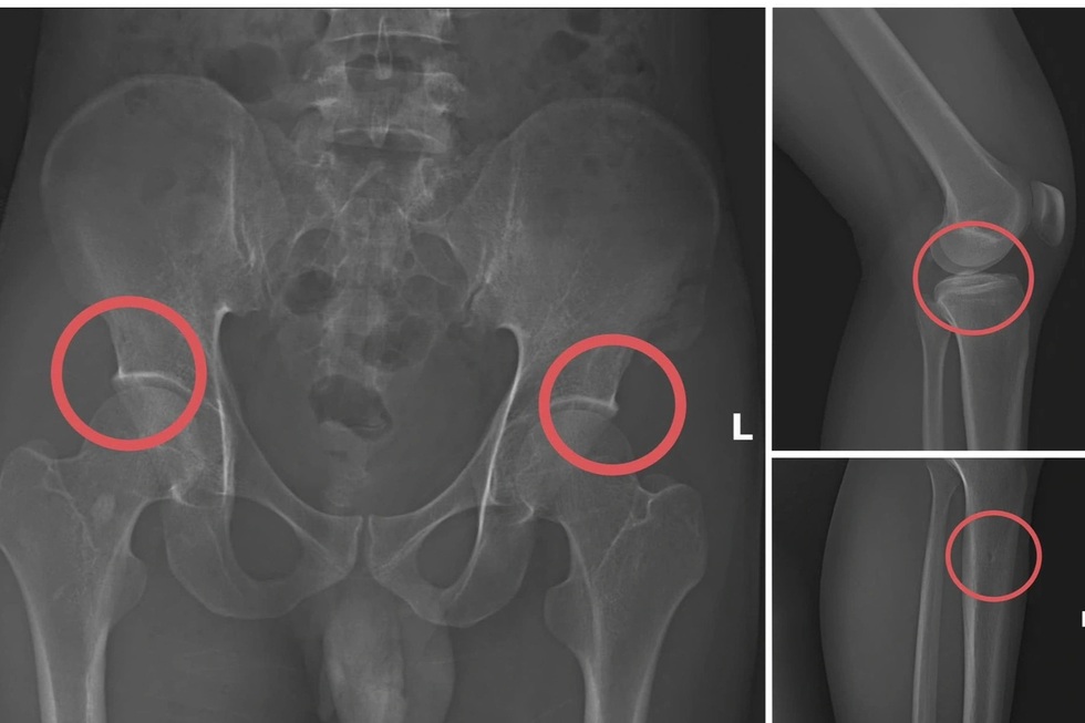 Tự đục vỡ xương để “qua mặt” bảo hiểm - 1
