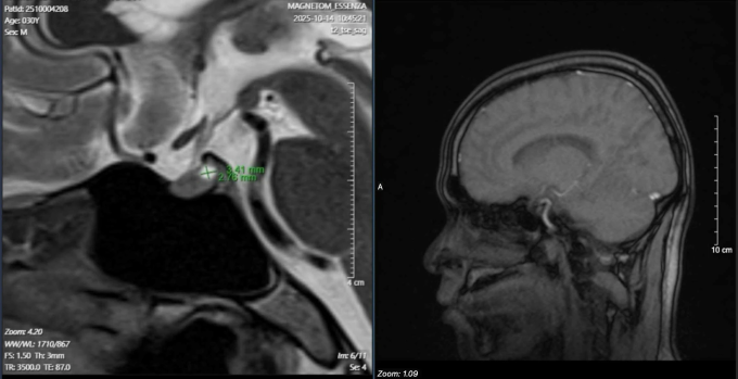 Hình ảnh khối y tuyến yên của bệnh nhân. Ảnh: Bác sĩ cung cấp