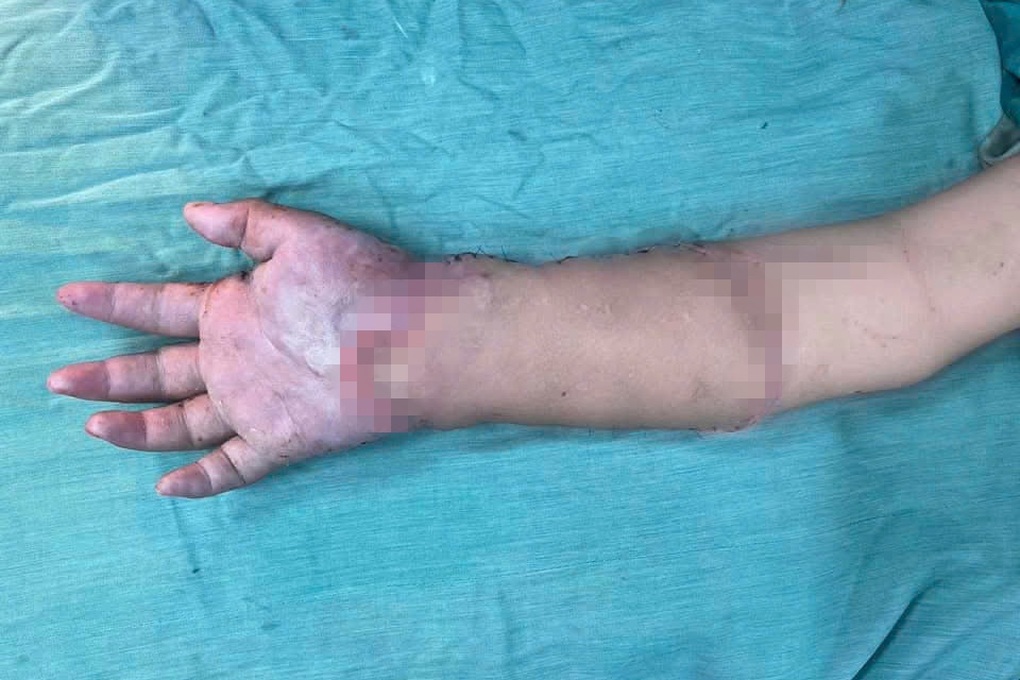 Sản phụ ghép tạm tay đứt lìa vào chân hạnh phúc khi 2 con trai chào đời - 2