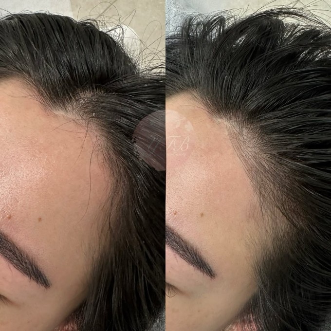 Điêu khắc đường chân tóc - cứu tinh cho tóc thưa mỏng 3 Các nét khắc tóc sẽ xen lẫn với tóc thật tạo ảo giác tóc dày và bồng bềnh hơn bình thường. Ảnh: Instagram yokototalbeauty