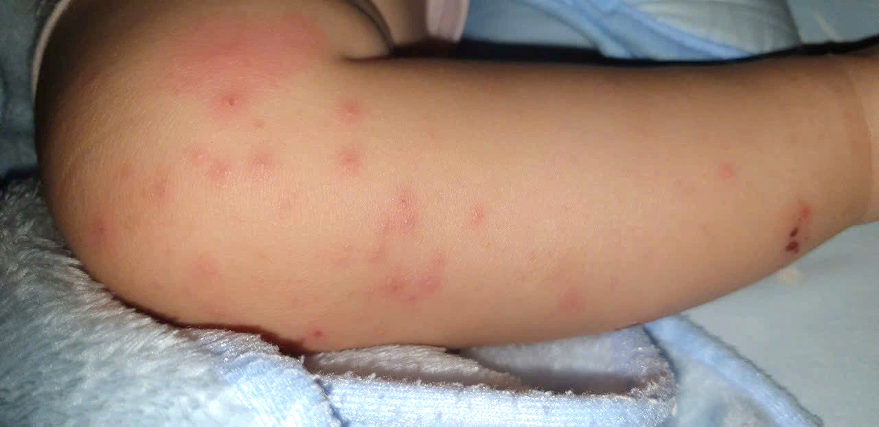 Chủng vi rút gây bệnh tay chân miệng nặng xuất hiện trở lại ở TP.HCM- Ảnh 2.