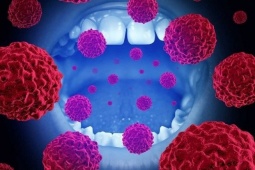 Những dấu hiệu phát hiện sớm ung thư miệng rất dễ bỏ qua