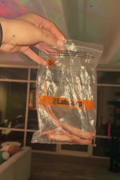 James giữ lại xương sườn sau phẫu thuật thu gọn vòng eo. Ảnh: Emily James