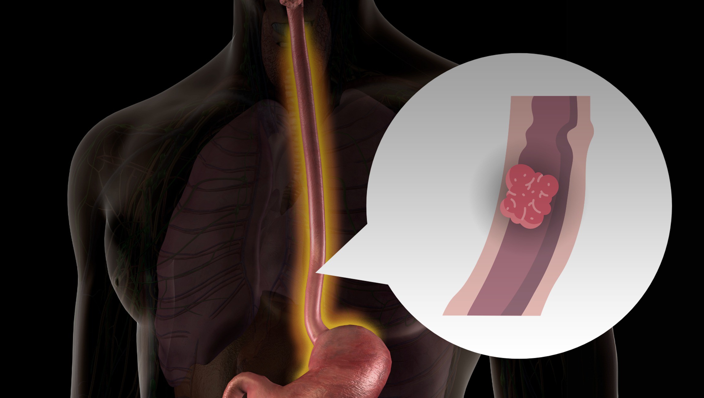 Những món người Việt yêu thích không ngờ làm tăng nguy cơ mắc ung thư thực quản 3 Những món người Việt yêu thích không ngờ làm tăng nguy cơ mắc ung thư thực quản - 2