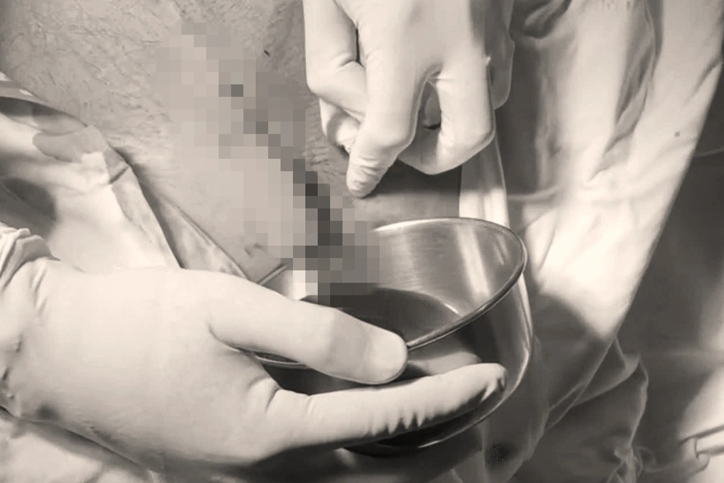 Nữ Việt kiều 60 tuổi tử vong vì biến chứng nặng sau khi hút mỡ, nâng ngực - 3