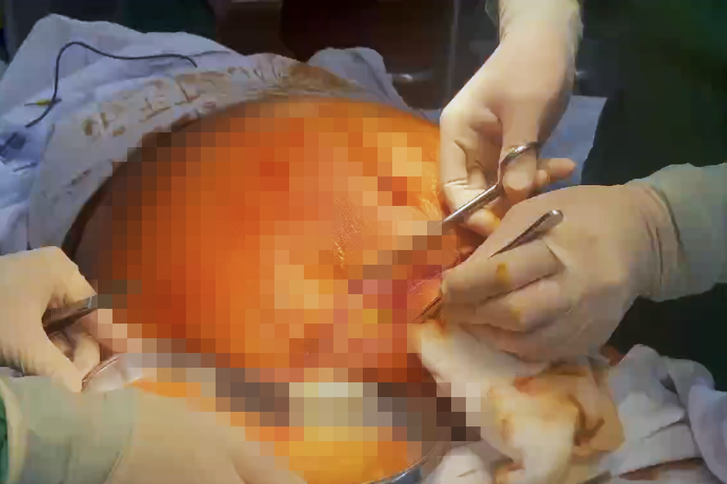 Người phụ nữ thủng ruột nguy kịch sau hút mỡ, 81 ngày chống chọi tử thần - 2