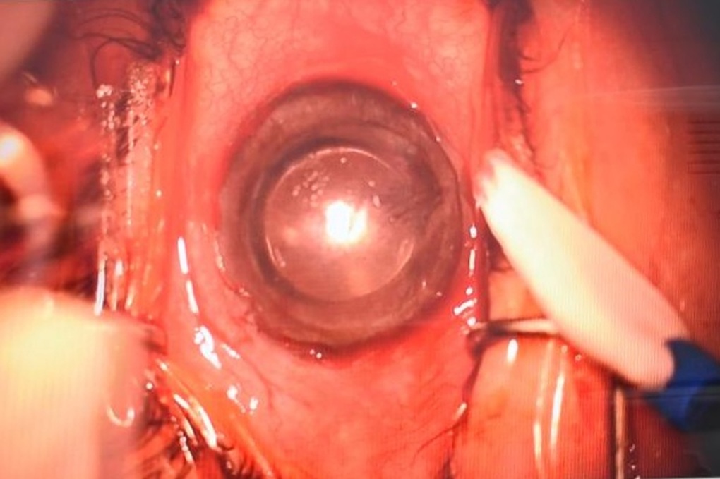 Giác mạc từ Nepal xuyên biên giới mang lại ánh sáng cho 12 bệnh nhân Việt - 2