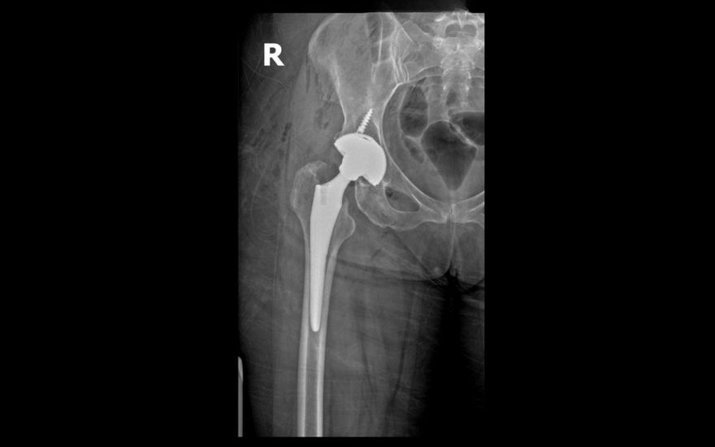 Bệnh nhân Israel lấy lại vận động nhờ thay khớp háng Superpath - 3