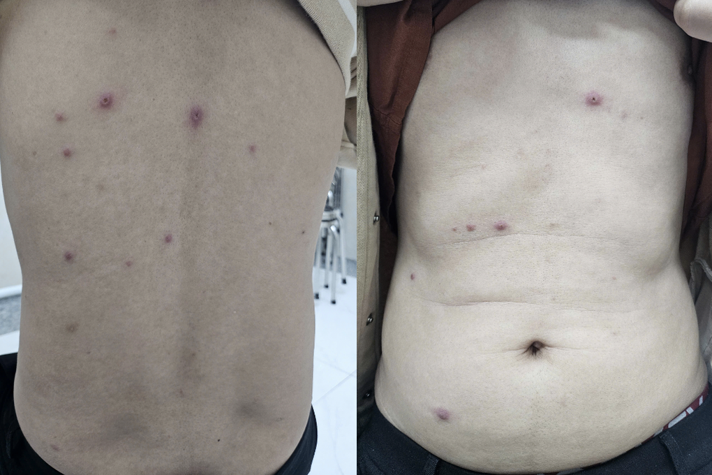 TPHCM: Nhiều chàng trai nhiễm bệnh hiểm sau quan hệ với bạn tình đồng giới - 2