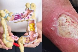 7 dấu hiệu trên da cảnh báo ung thư đại tràng, ai cũng cần biết