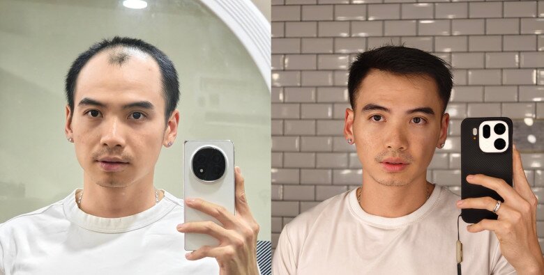 Chồng H'Hen Niê khoe diện mạo mới hậu "phẫu thuật", không còn hình ảnh tự ti khi đứng cạnh vợ hoa hậu 2 Nhiếp ảnh gia Tuấn Khôi khoe diện mạo mới sau 6 tháng cải thiện tình trạng hói tóc.