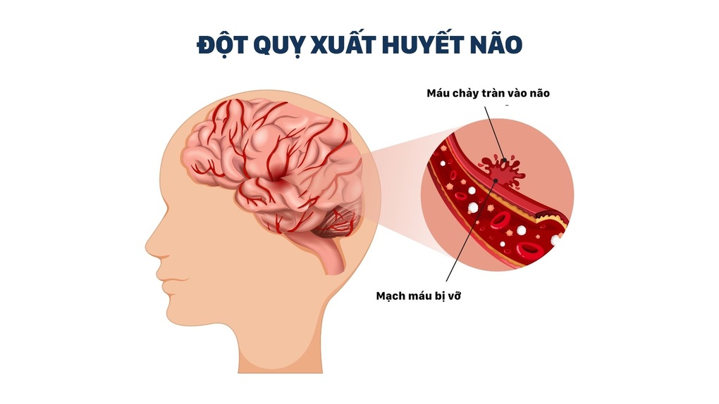 Đau đầu dữ dội, bất thường: Có thể là tín hiệu xuất huyết não nguy hiểm - 2