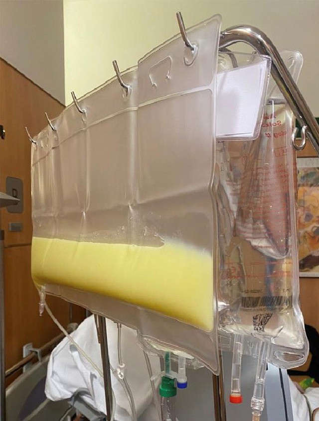 Người đàn ông 47 tuổi ở Quảng Ninh viêm tụy tái phát thừa nhận có thói quen nhiều người Việt mắc phải 3 Các bác sĩ đã thay huyết tương, lọc máu liên tục, cứu sống bệnh nhân. Ảnh: BVCC