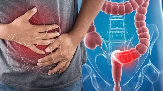 4 thói quen tăng nguy cơ ung thư đại trực tràng, người Việt nhất định phải tránh 7 Ảnh minh họa.