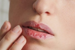 5 cách trị môi khô nẻ với nguyên liệu tại nhà
