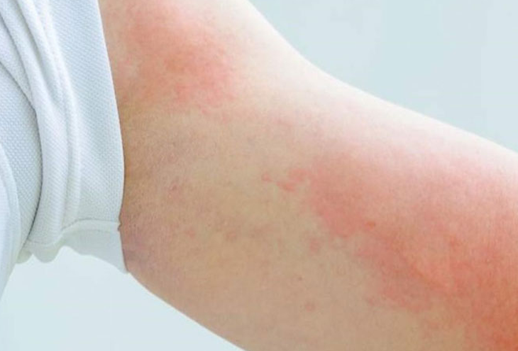 Nữ giáo viên nhập viện nguy kịch sau khi ăn bún ngan - Ảnh 2.