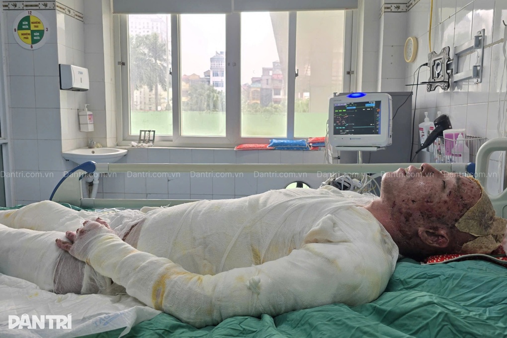 Gia cảnh kiệt quệ của người bố đơn thân bị bỏng khí gas mong được sống - 5