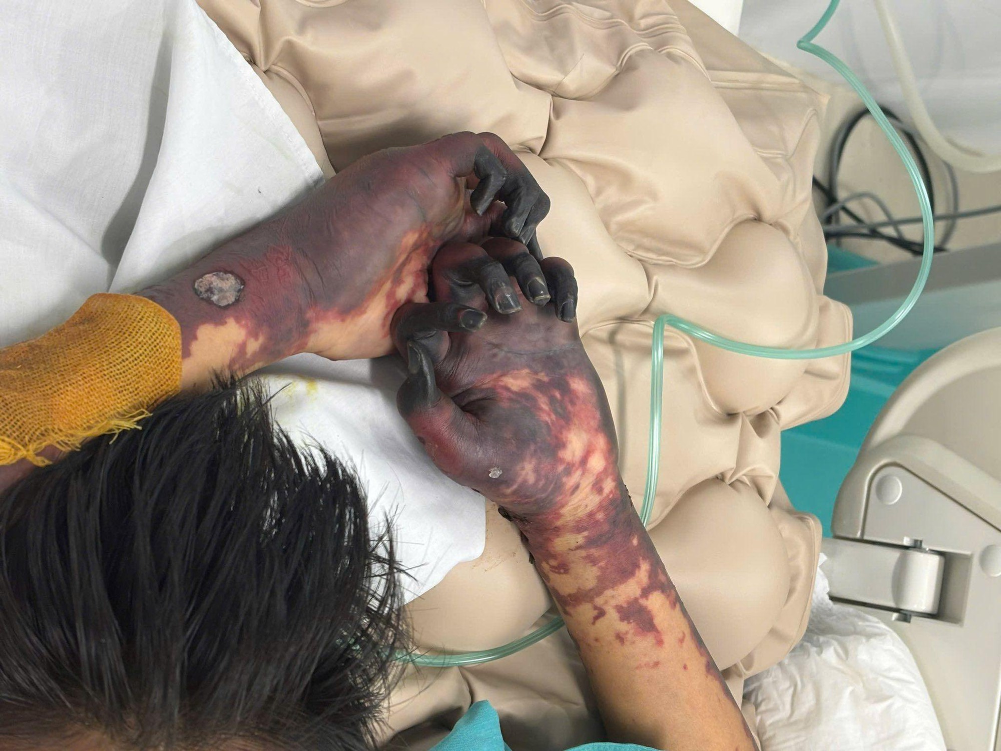 Ngỡ chỉ cảm cúm, cầu thủ Pháp phải cắt một chân do não mô cầu 2 VNVC - Ảnh 3.