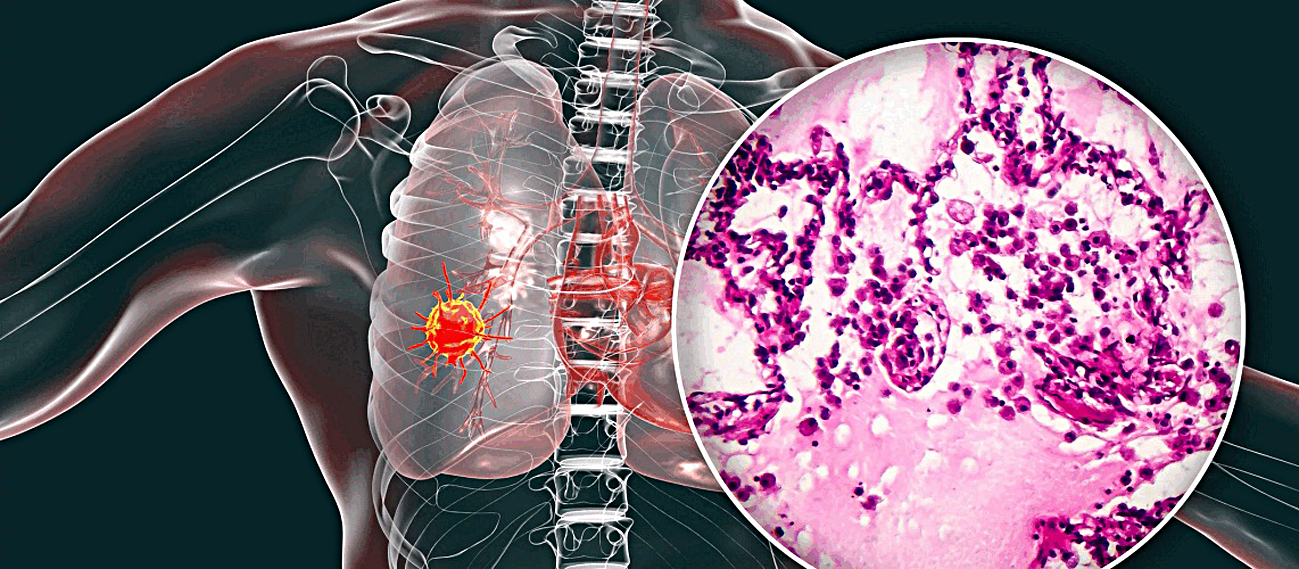 Cuộc chiến trường kỳ chống ung thư - Kỳ 4: Phép màu cho người ung thư giai đoạn cuối 2 Cuộc chiến trường kỳ chống ung thư - Kỳ 4: Phép màu cho người ung thư giai đoạn cuối - Ảnh 2.