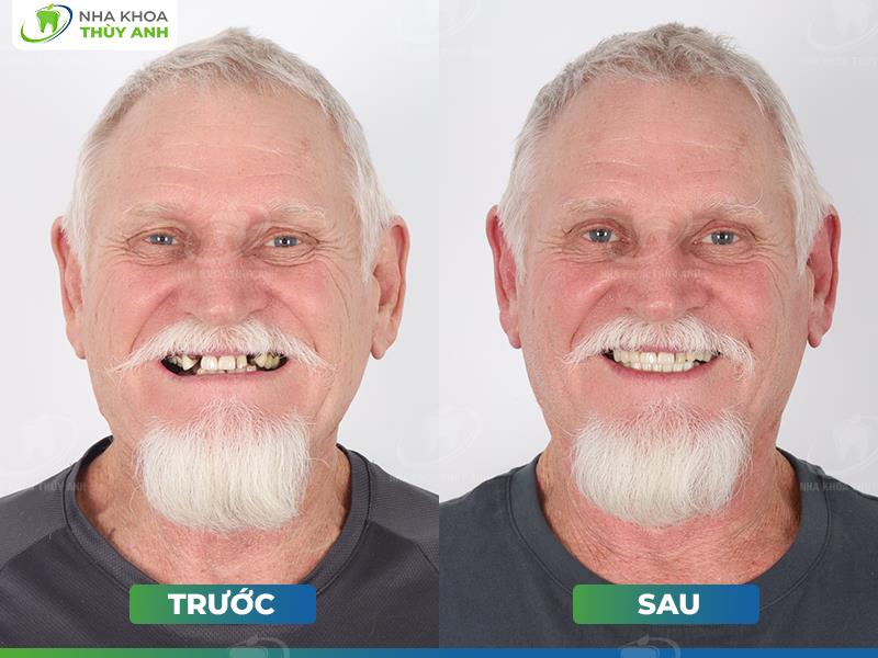 Nha khoa Thùy Anh đón loạt khách nước ngoài tới Việt Nam làm răng- Ảnh 3. Nha khoa Thùy Anh đón loạt khách nước ngoài tới Việt Nam làm răng- Ảnh 3.