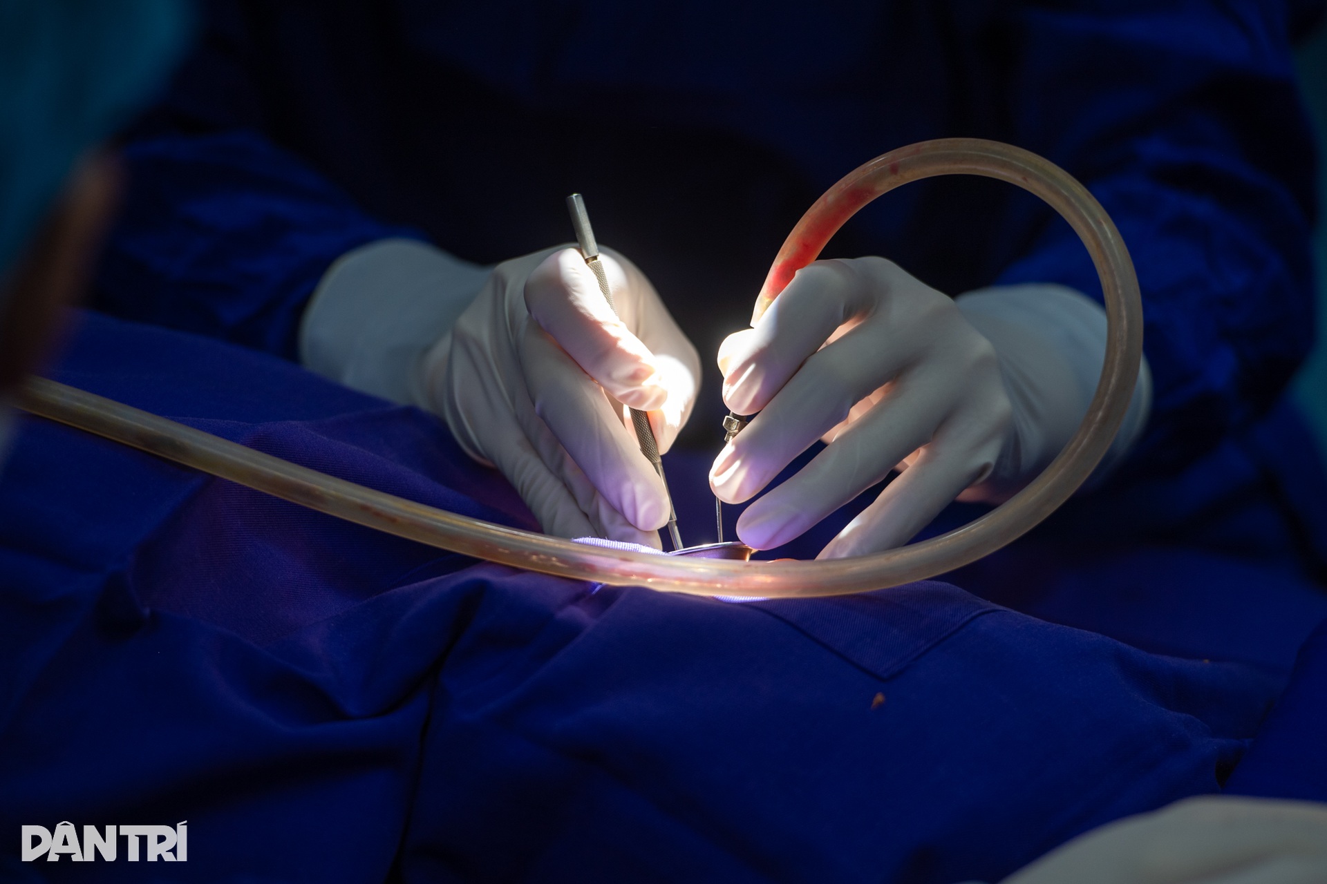 Hồi hộp xem bác sĩ cấy tai máy mang thanh âm cho em bé khiếm thính - 9